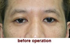 plastic-surgery-blepharoplasty